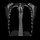 Osteopathia striata, systemic bone disorder: CT - Computed tomography